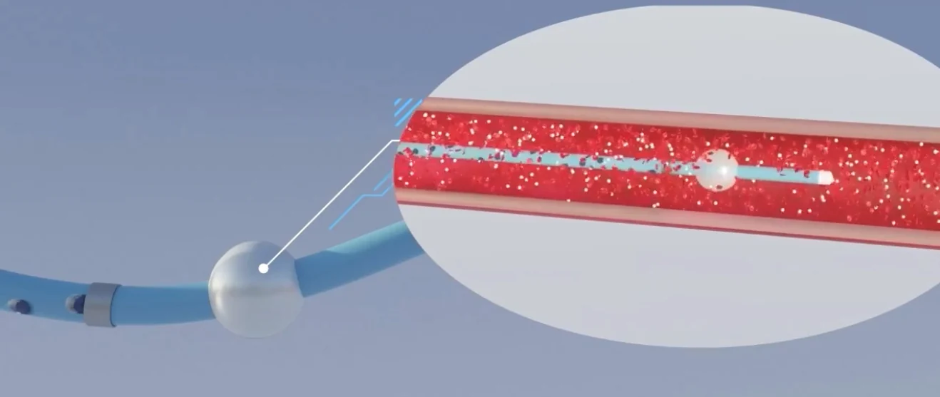 Official technical illustration of the catheter infusion segment